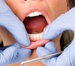 San Antonio TX Oral Cancer Screenings