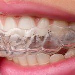 San Antonio TX Adult Clear Braces