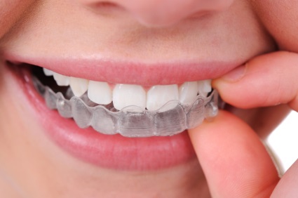 Clear Aligner