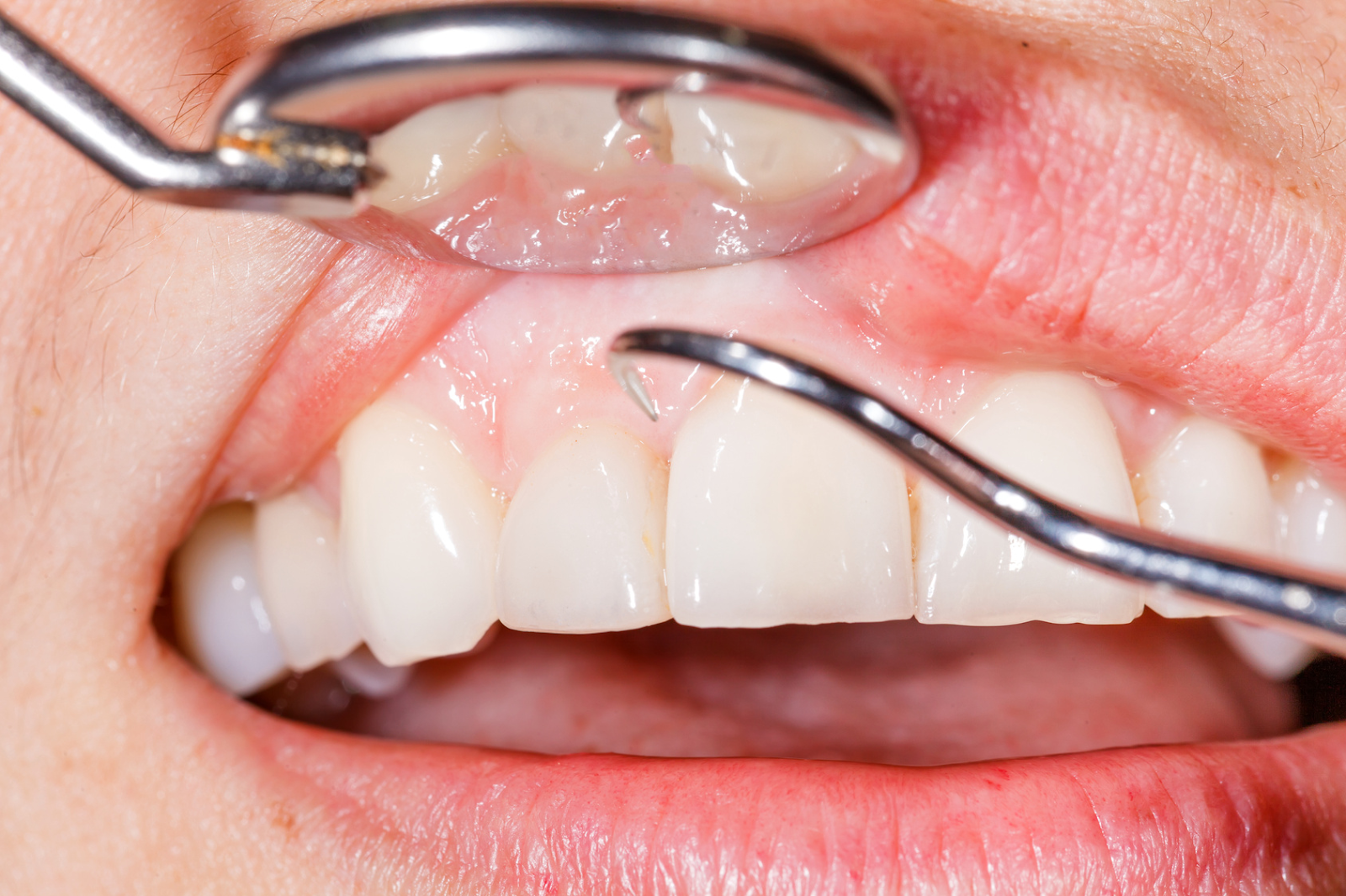 Periodontal Care