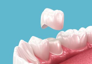 Dental Crowns San Antonio